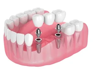 Dental Implants in China