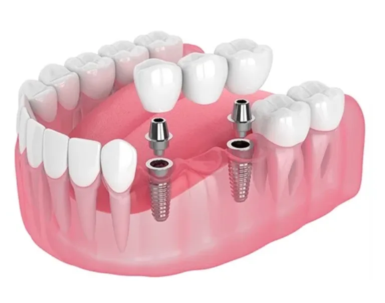Dental Implants in China