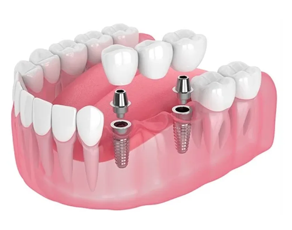Dental Implants in China